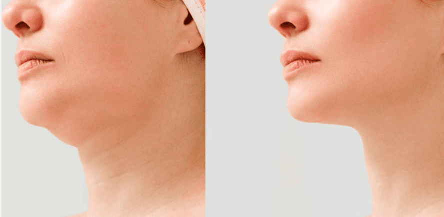 Redução De Papada Com 5 Sessões De Carboxiterapia + Enzima Redutora